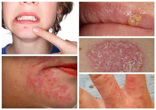 Alergias e doenças de pele são sinais de parasitas no corpo
