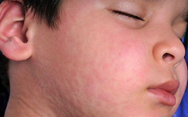Erupções alérgicas na pele - um sintoma da presença de vermes parasitas no corpo